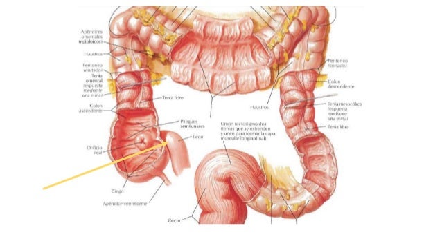 diverticulo de meckel